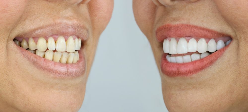 Smile transformation before-and-after result